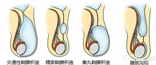 宝宝疝气嵌顿手术要做吗?