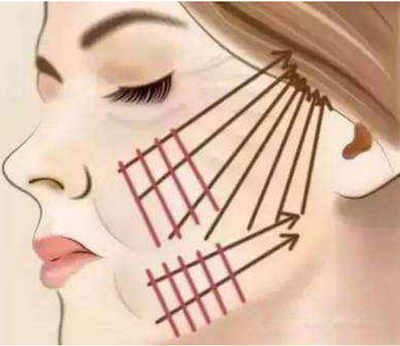脸部埋线提升术、脸部提升埋线、脸部埋线提升过程图片