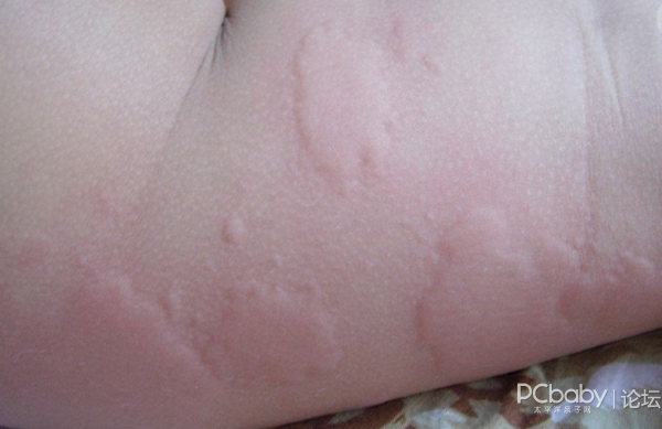 小儿荨麻疹四季高发,如果不注意这一点,很容易让宝宝反复病发