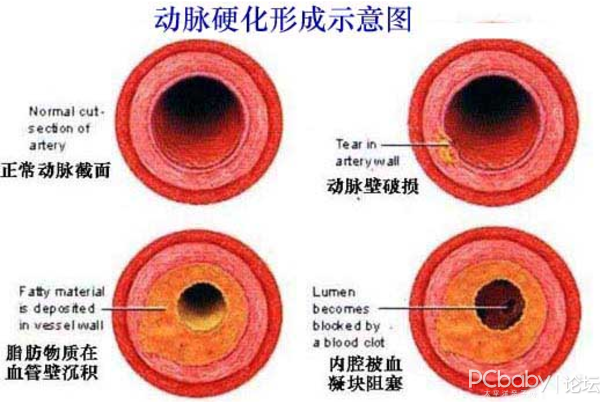 引起动脉硬化的原因