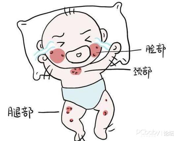 宝宝湿疹是怎么引起的原因是什么宝宝湿疹抹点什么