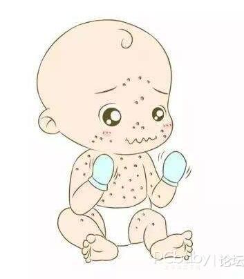 宝宝身体出现了不同类型的过敏导致而成,那么,婴儿湿疹一定是过敏吗?