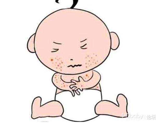 婴儿湿疹如何护理