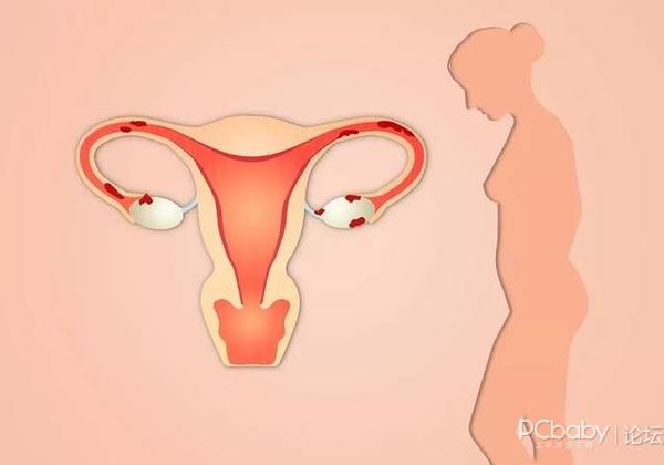 女性宫颈癌的早期症状有哪些?