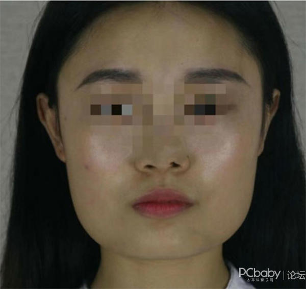 咬肌肥大和骨骼大图片对比 咬肌软了是开始瘦了吗
