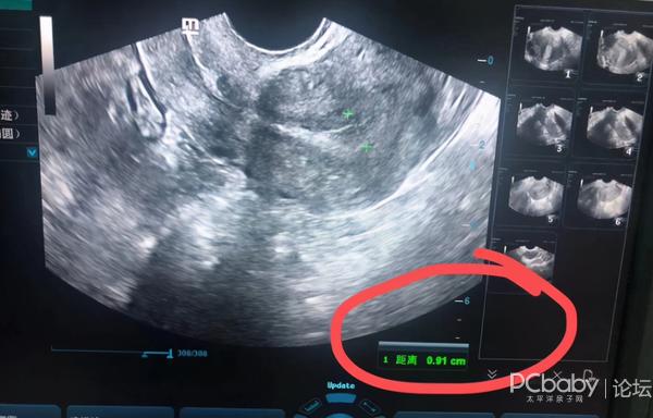 子宫内膜薄是怎么回事太可怕了能治好吗?