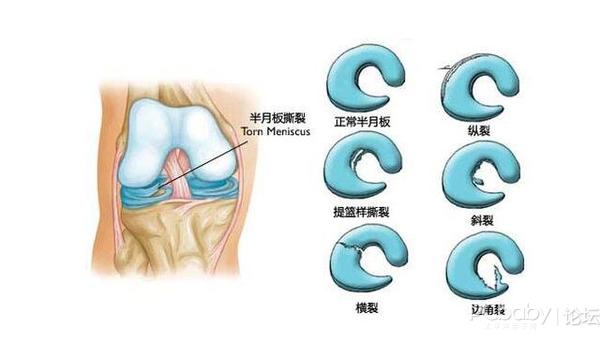半月板损伤可以治愈吗