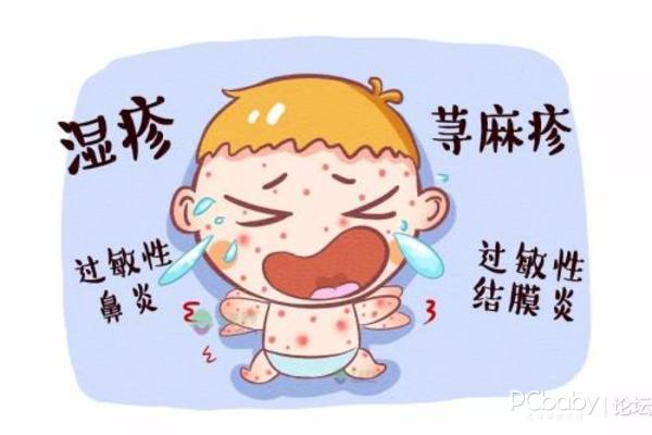 寶寶患了溼疹金銀花水能夠治療好嗎?