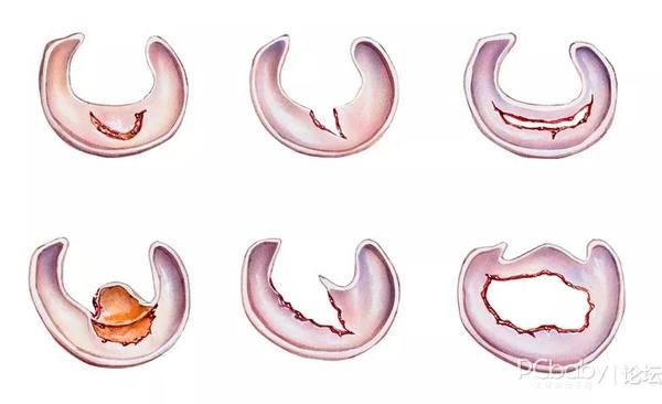 半月板損傷的症狀及治療方法_美食分享_論壇_太平洋親子網