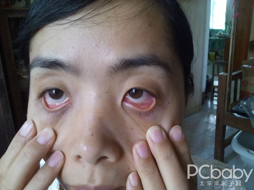 我是否得了红眼病