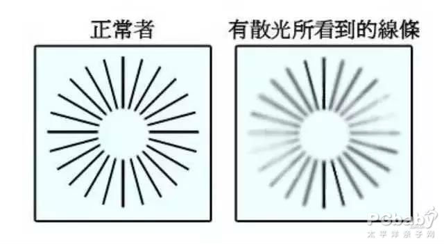 眼睛散光是怎么形成的,眼睛散光是怎么形成的?危害有多大?